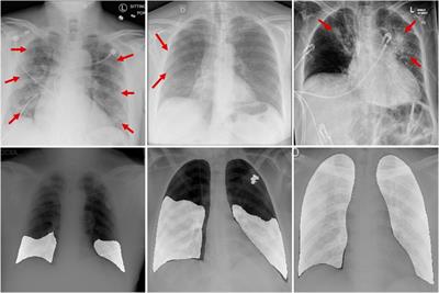 ERGPNet: lesion segmentation network for COVID-19 chest X-ray images based on embedded residual convolution and global perception